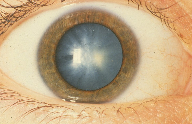 Cataracts