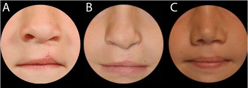 3 different cleft lips and palates