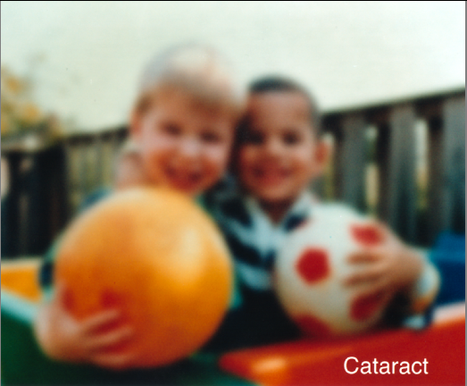 Vision with cataracts