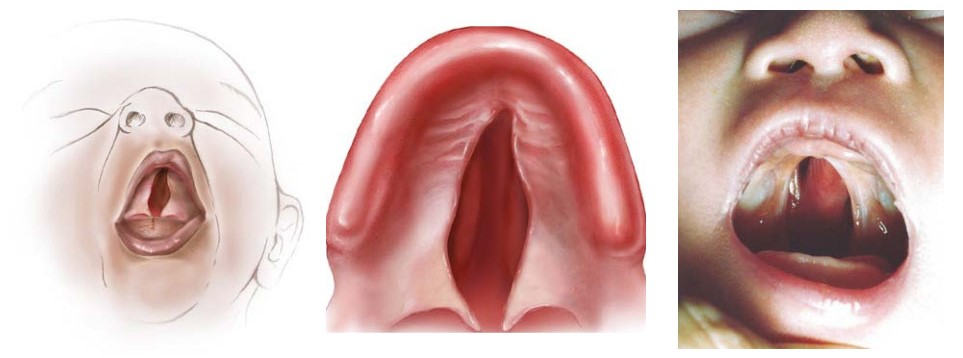 Medical diagram of infant with cleft palate condition