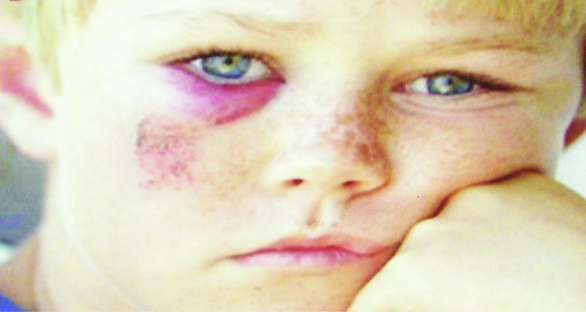 Child with an eye injury