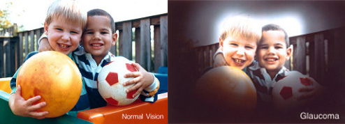 Normal vision versus vision with glaucoma