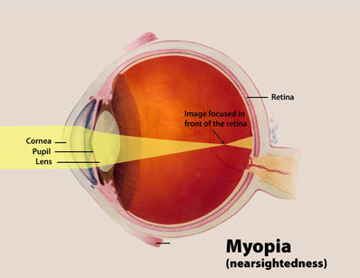 Myopia diagram