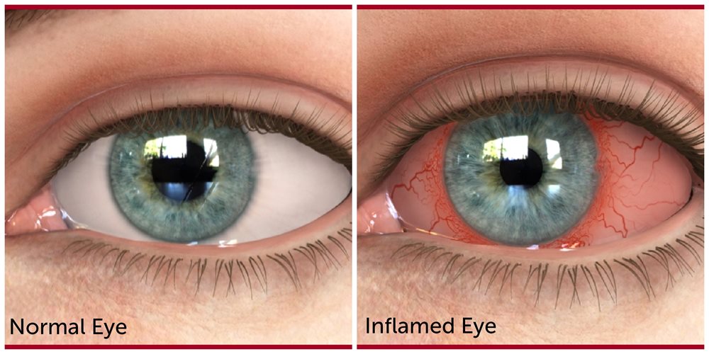 Normal eye versus inflamed eye